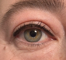 After Excision of right medial cantal epidermal inclusion cyst