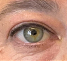 Before Excision of right medial cantal epidermal inclusion cyst