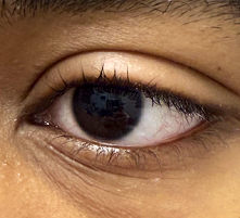 After Excision of left lower lid margin milium cyst