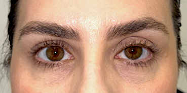 Upper and lower eyelid blepharoplasty with upper eyelid ptosis surgery Before