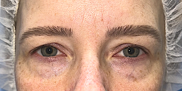 Before Bilateral upper eyelid blepharoplasty witheyelid repositioning and internal brow fixation