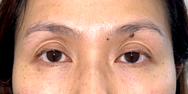Upper and lower eyelid blepharoplasty with upper eyelid ptosis surgery Before