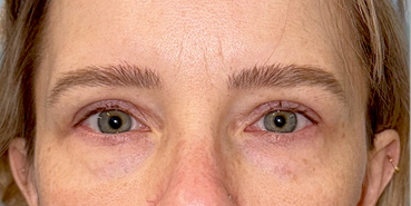 After Bilateral upper eyelid blepharoplasty witheyelid repositioning and internal brow fixation