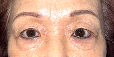 After Upper and lower eyelid blepharoplasty with upper eyelid ptosis surgery