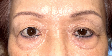 Upper and lower eyelid blepharoplasty with upper eyelid ptosis surgery Before