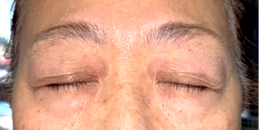 After Upper eyelid blepharoplasty with brow lift