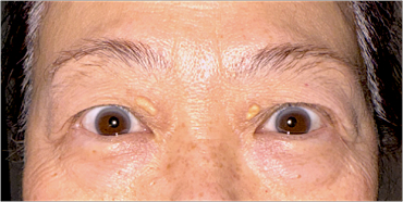 Before Upper eyelid blepharoplasty with brow lift