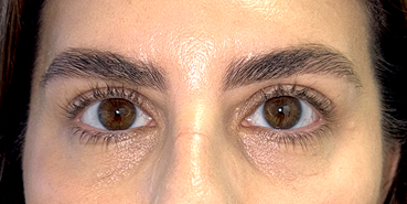 After Upper and lower eyelid blepharoplasty with upper eyelid ptosis surgery