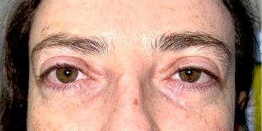 After Upper and lower eyelid blepharoplasty with upper eyelid ptosis surgery
