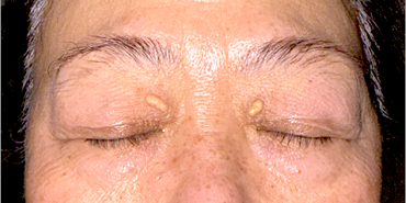 Before Upper eyelid blepharoplasty with brow lift