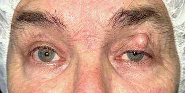 Upper and lower eyelid blepharoplasty with upper eyelid ptosis surgery Before