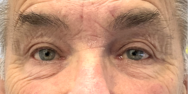 After Upper and lower eyelid blepharoplasty with upper eyelid ptosis surgery