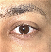 Immediately after Right lower lid cosmetic nevus excision and reconstruction