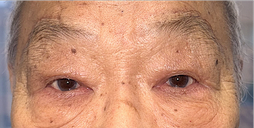 After Upper and lower eyelid blepharoplasty with upper eyelid ptosis surgery