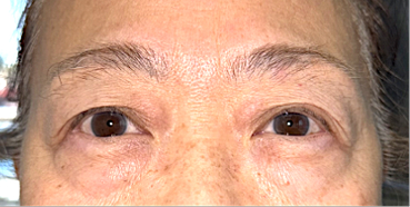 After Upper eyelid blepharoplasty with brow lift