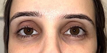 Upper and lower eyelid blepharoplasty with upper eyelid ptosis surgery Before