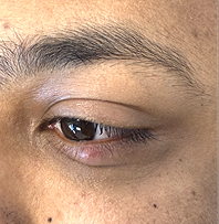 Before Right lower lid cosmetic nevus excision and reconstruction