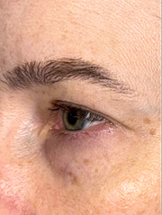Before Bilateral upper eyelid blepharoplasty witheyelid repositioning and internal brow fixation left view