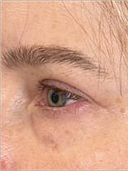 After Bilateral upper eyelid blepharoplasty witheyelid repositioning and internal brow fixation right view
