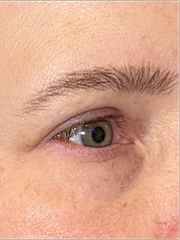 After Bilateral upper eyelid blepharoplasty witheyelid repositioning and internal brow fixation left view left view