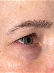 Before Bilateral upper eyelid blepharoplasty witheyelid repositioning and internal brow fixation left view