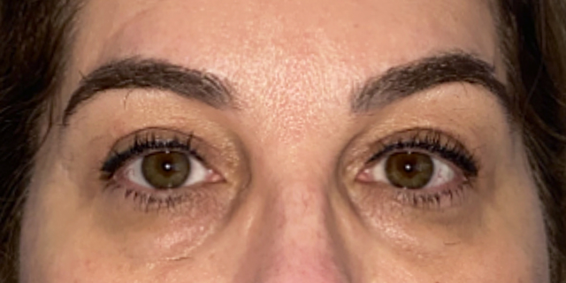 After Bilateral upper eyelid blepharoplasty