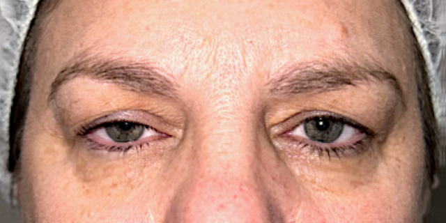 Before Bilateral upper eyelid blepharoplasty witheyelid repositioning and internal brow fixation