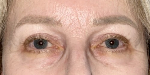 After Bilateral upper eyelid blepharoplastywith eyelid repositioning
