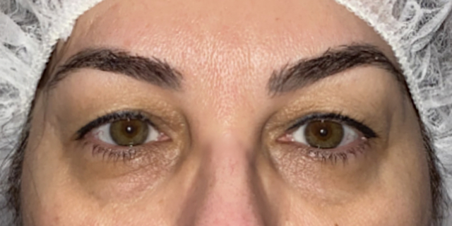 Before Bilateral upper eyelid blepharoplasty