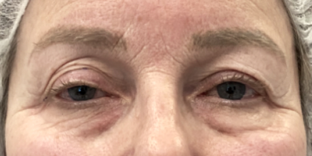 Before Bilateral upper eyelid blepharoplastywith eyelid repositioning