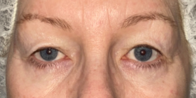 Before Bilateral upper eyelid blepharoplastywith right upper eyelid repositioning