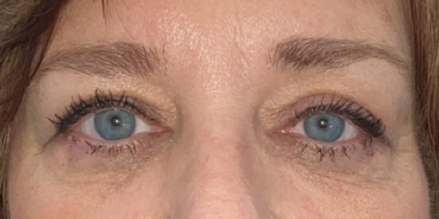 After Bilateral upper eyelid repositioning