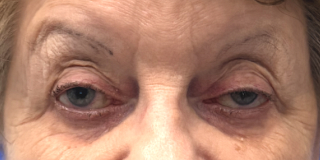 Before Bilateral upper eyelid blepharoplasty with eyelid repositioning