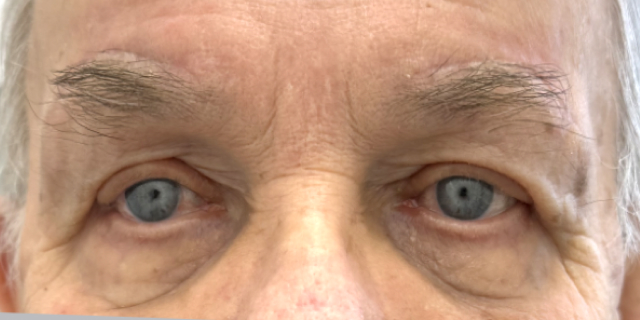 After Bilateral upper eyelid blepharoplastywith direct browplasty
