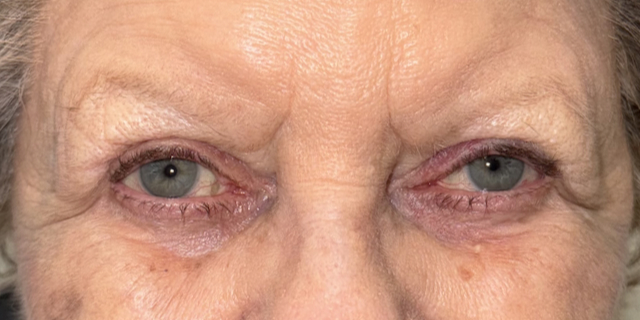 After Bilateral upper eyelid blepharoplasty with eyelid repositioning