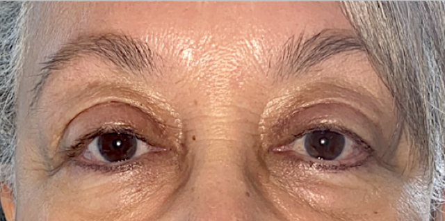 After Bilateral upper eyelid blepharoplasty with eyelid repositioning