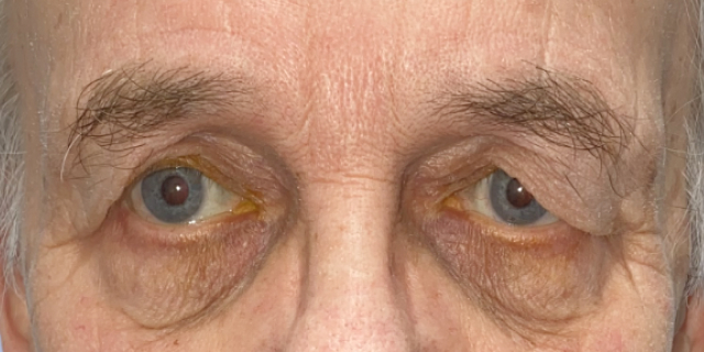 before Bilateral upper eyelid blepharoplastywith direct browplasty