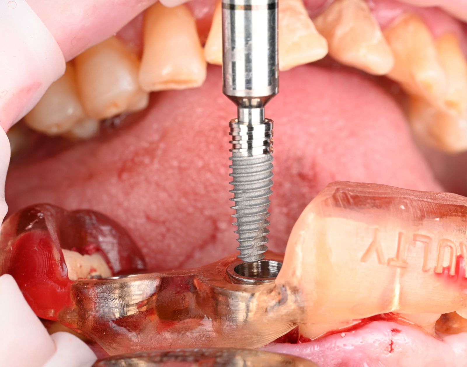 Pose de l'implant à travers le guide chirurgical
