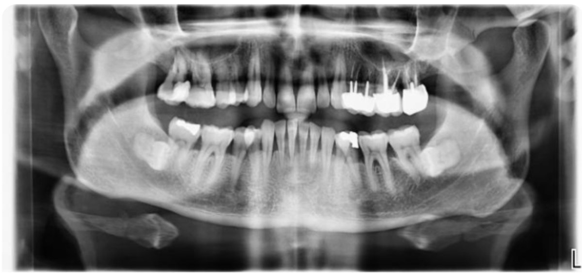 Radiographie panoramique pré-opératoire montrant l'alvéolyse complète de la 11 et la perte osseuse sur le secteur antérieur