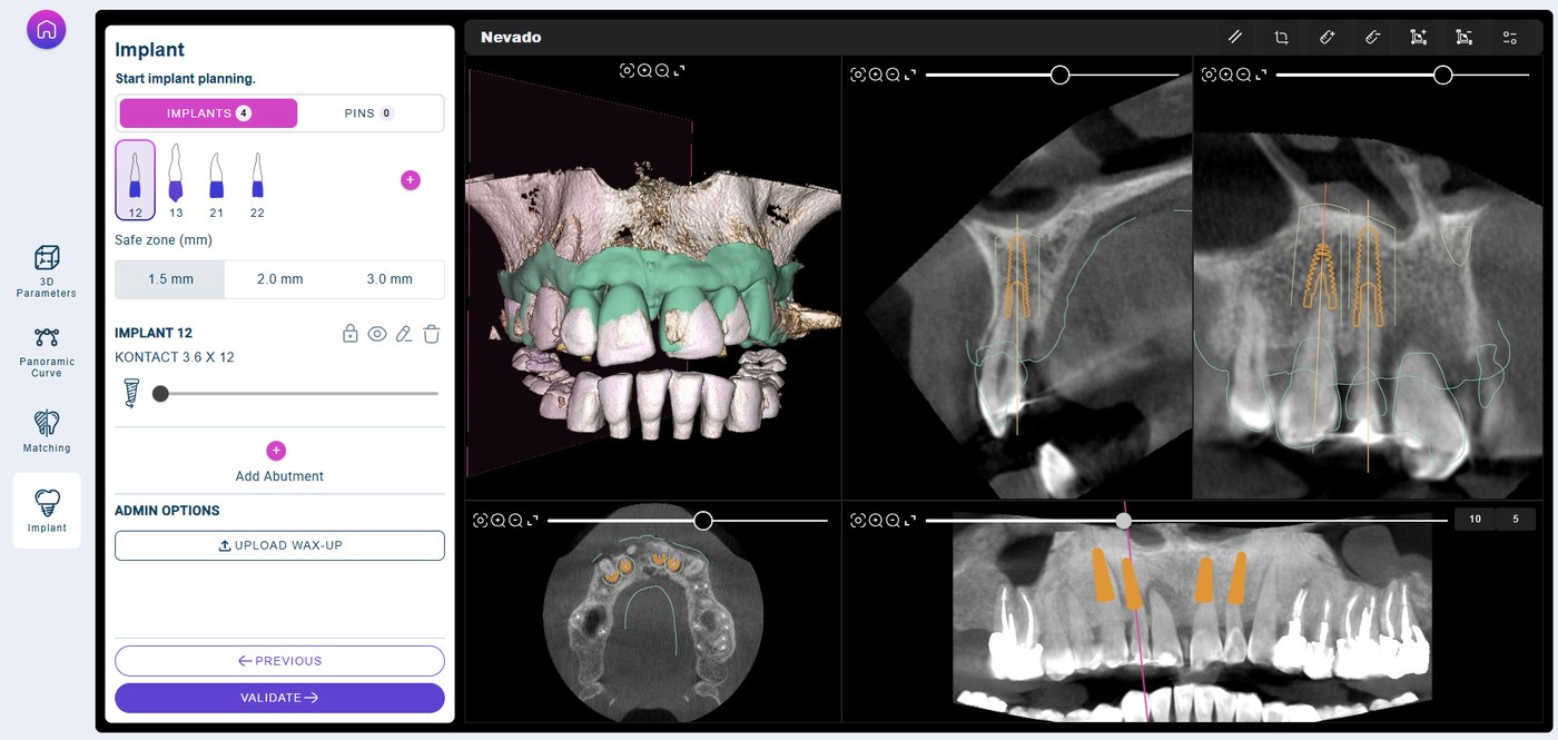 Planification des quatre axes implantaires dans le logiciel Inventeeth avec contrôle sur coupes CBCT