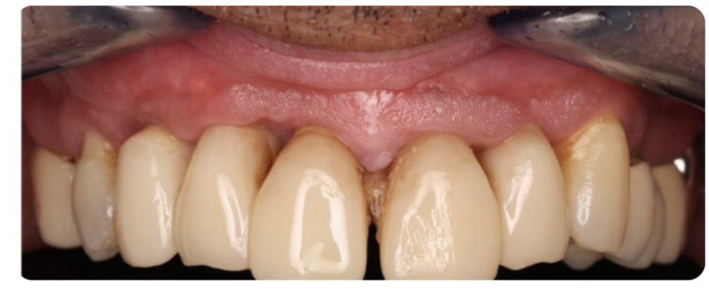 Résultat esthétique à 5 mois post-opératoire avec restitution des volumes gingivaux