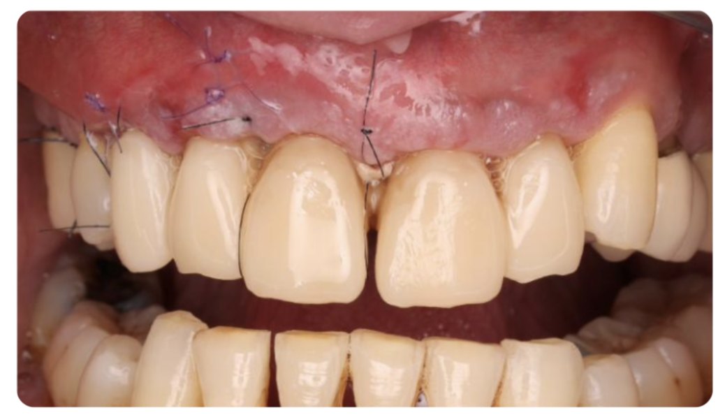 Contrôle de cicatrisation à J+12 sur les implants du secteur antérieur, sans déhiscence