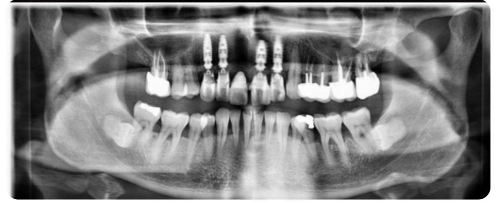 Radiographie panoramique de contrôle confirmant l'intégration des quatre implants