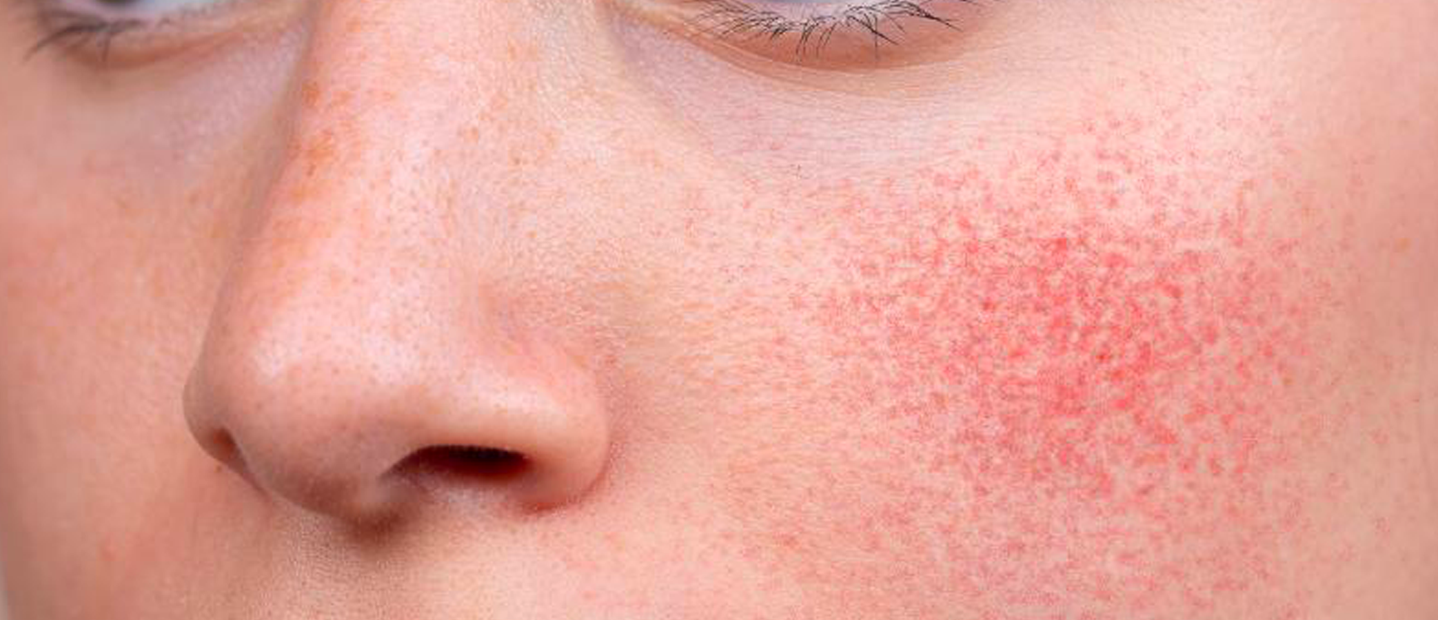 Soothe the Flame: A No-Fuss Guide to Calming Skin Inflammation