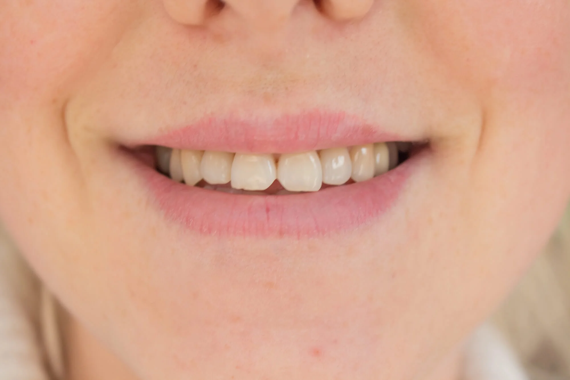 before Cosmetic Dentistry in Dallas TX