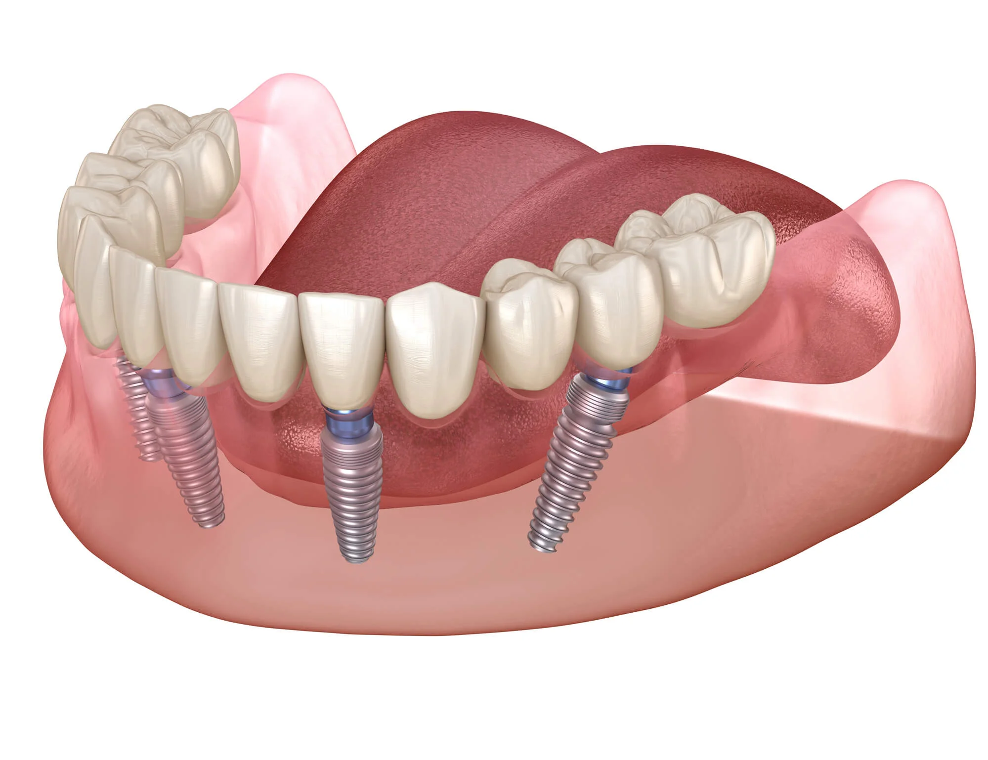 Full arch restoration with implants – All-on-4 implants in Dallas