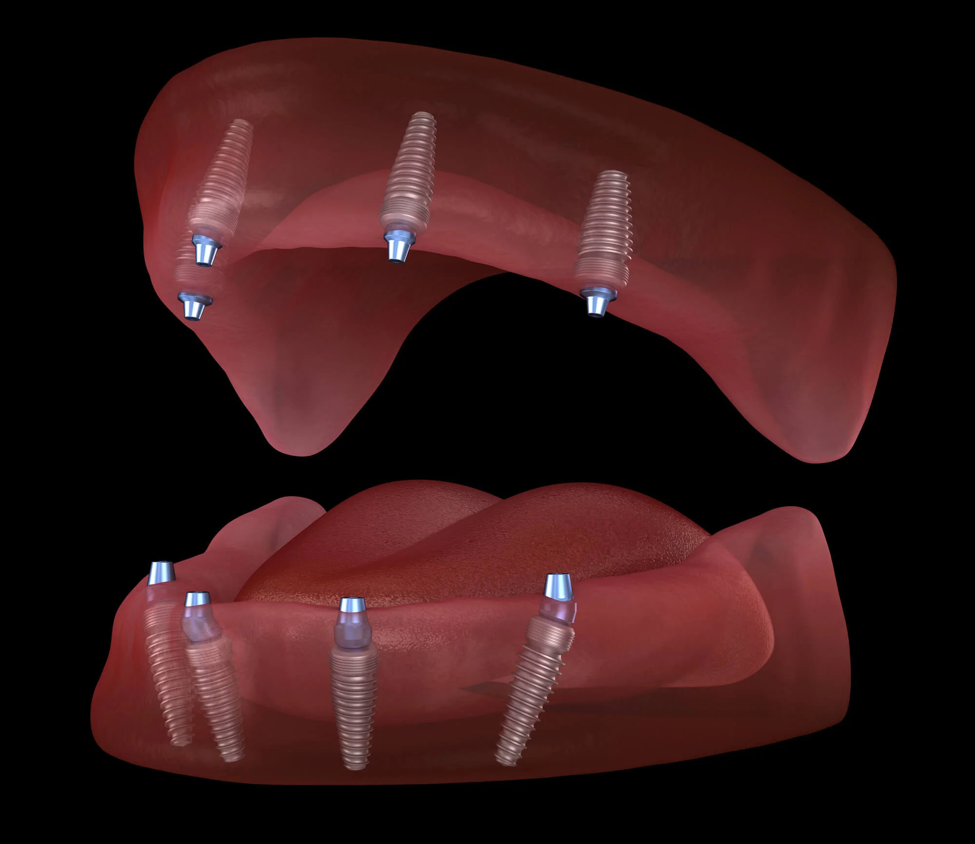 All-on-4 implant placement diagram – All-on-4 implants in Dallas