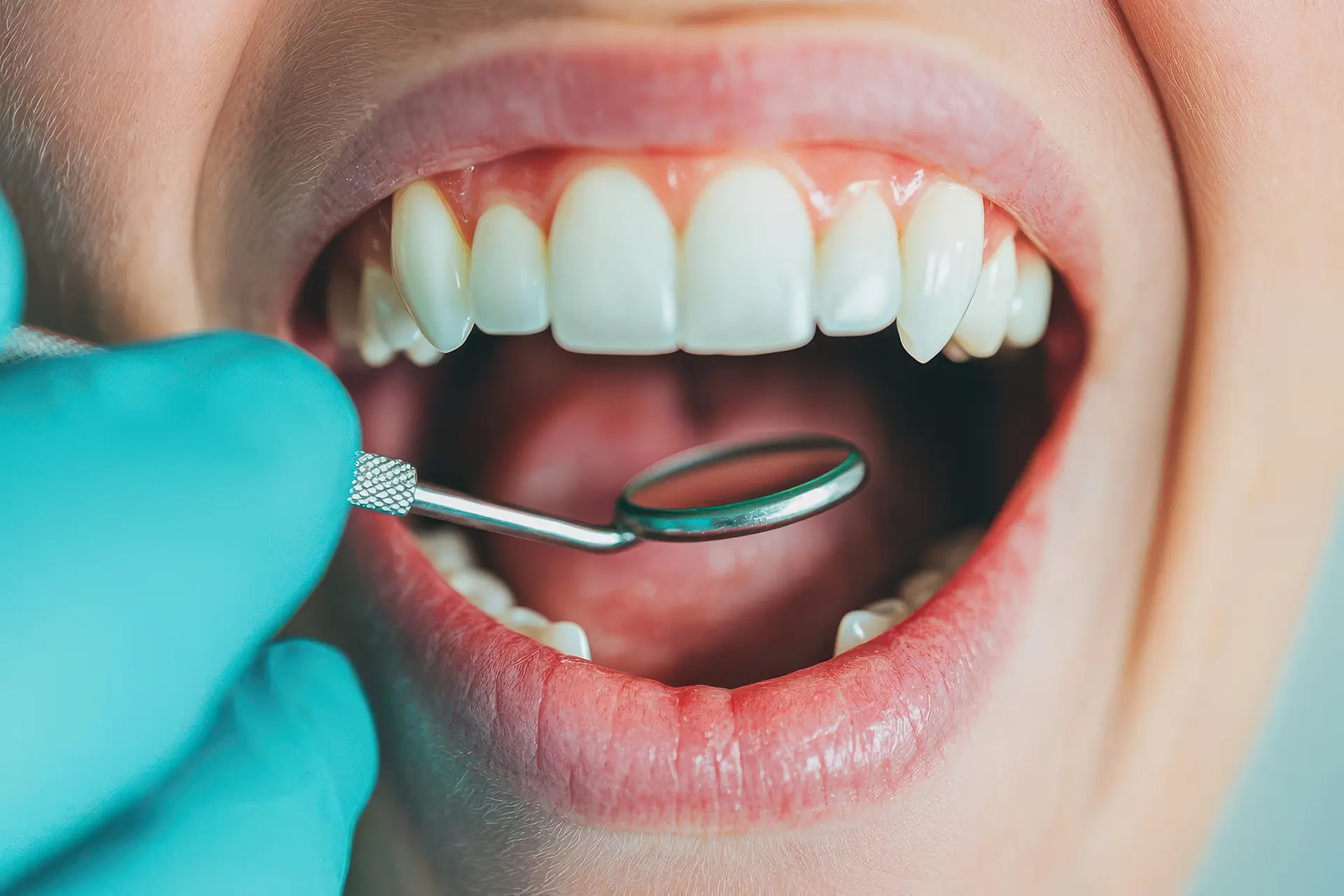 Dental Sealants