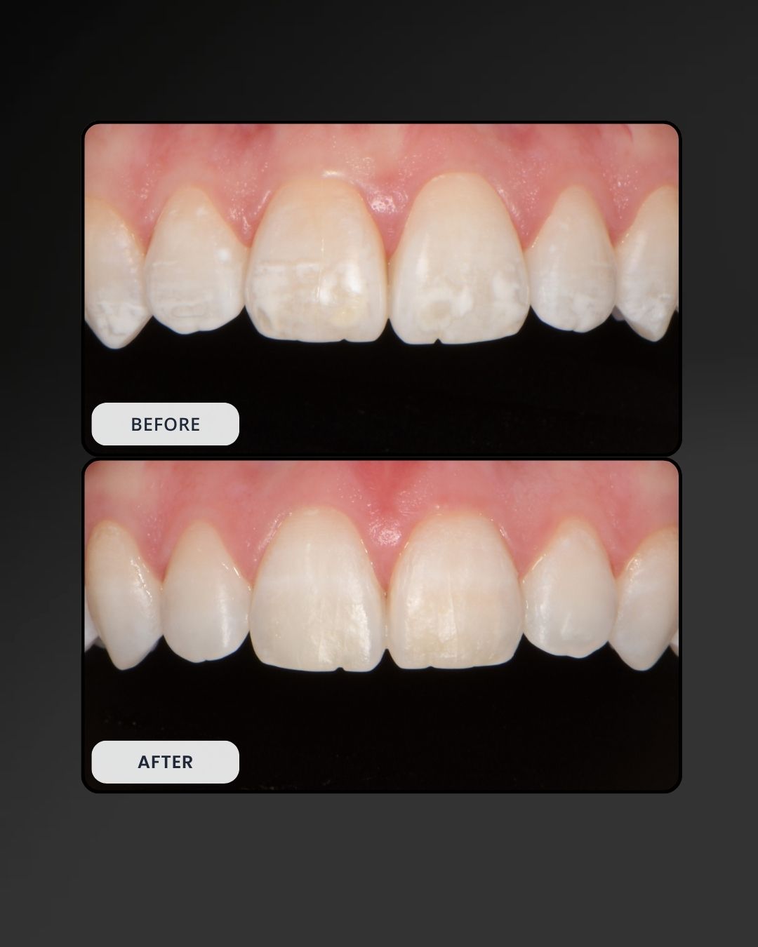 ICON White Spot Lesion Removal