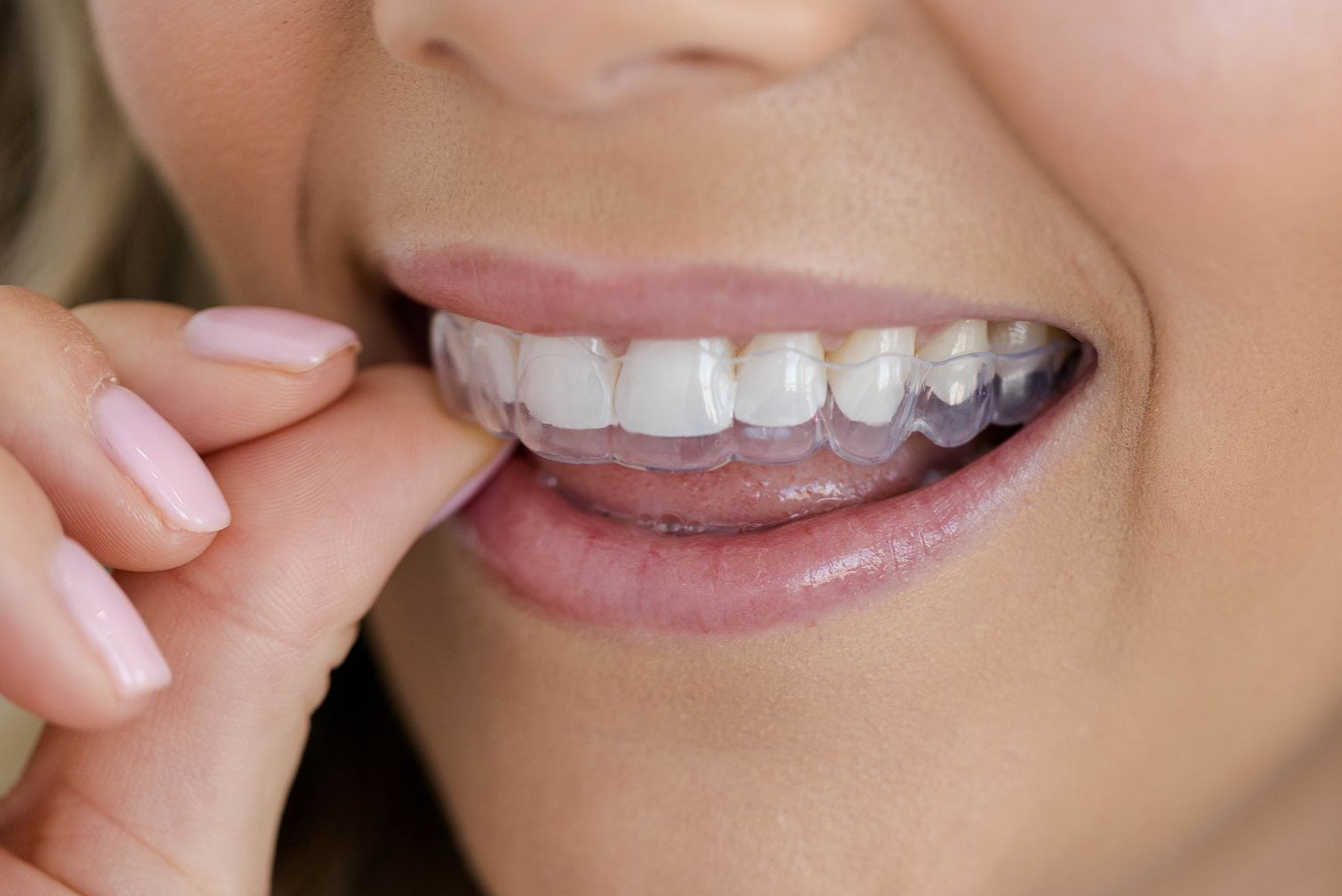 SureSmile Clear Aligners
